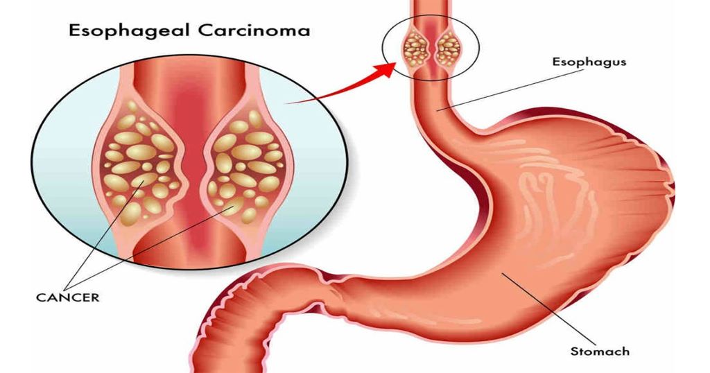 Esophagus Treatment in Hyderabad