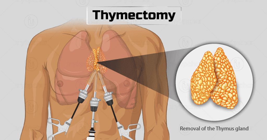 Thymoma Treatment in Hyderabad 