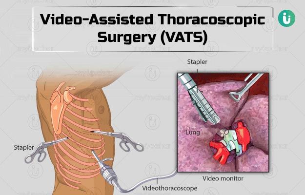 Video Assisted Thoracic Surgery Hyderabad 